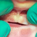 Image of tongue-tie