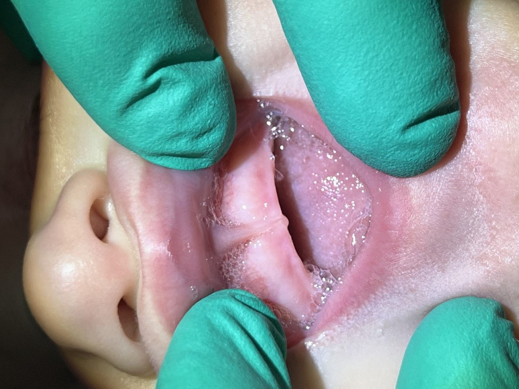 Image of tongue-tie