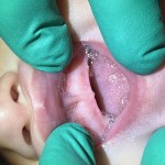 Image of tongue-tie