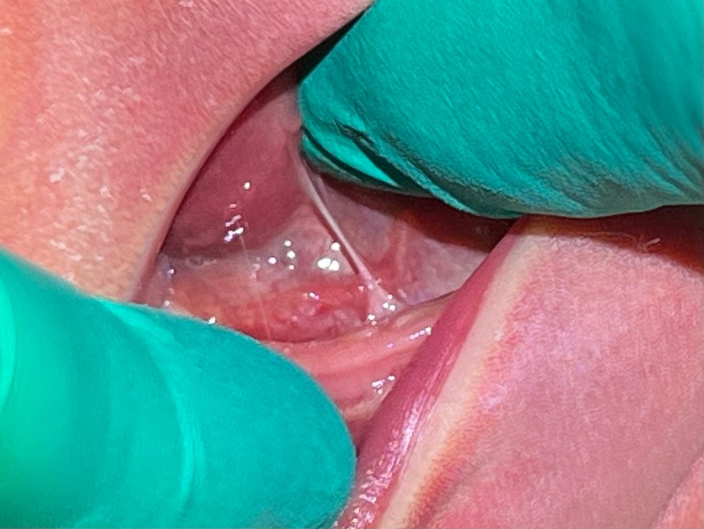 Image of tongue-tie