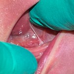 Image of tongue-tie